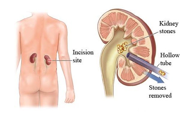 การผ่าตัดผ่านผิวหนังเพื่อนำนิ่วในไตออก Percutaneous Nephrolithotomy – PCNL